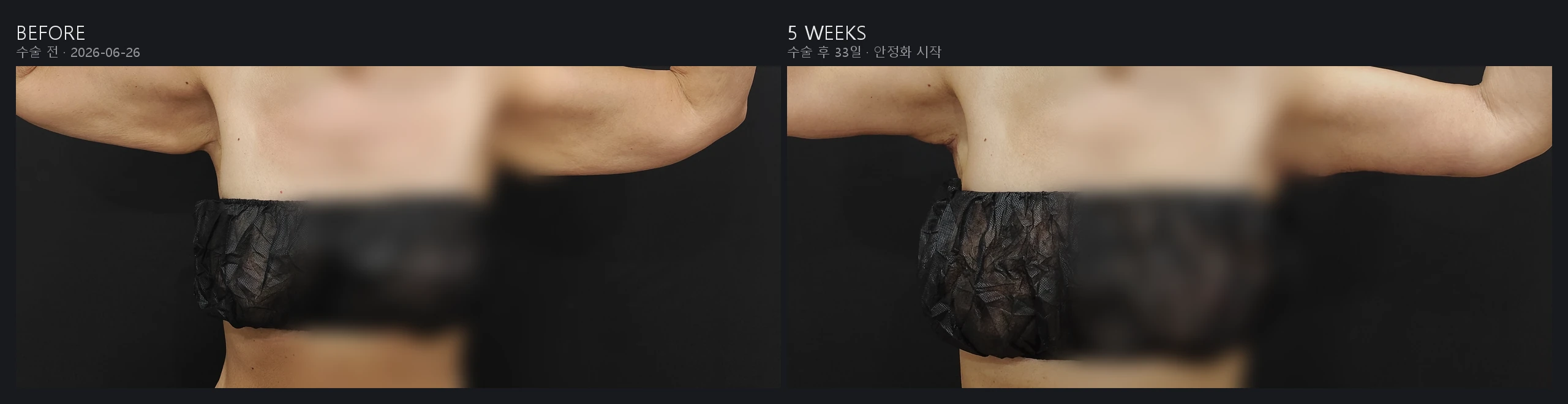 Arm lift brachioplasty before and after, front view, 5 weeks post-op – Evita Clinic Seoul