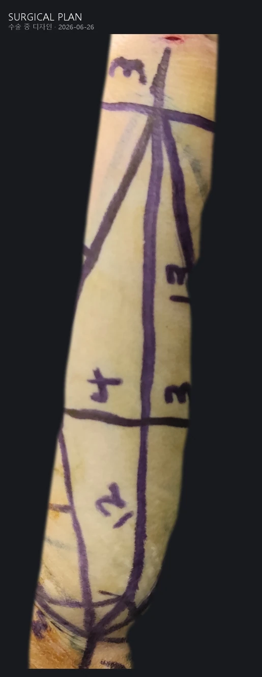 Brachioplasty surgical marking showing the planned skin excision along the inner upper arm – Evita Clinic Seoul