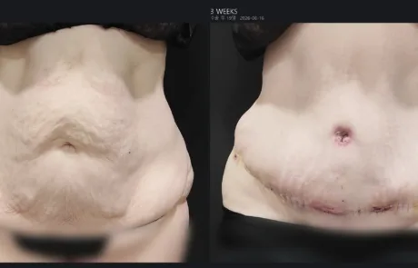 Tummy tuck before and after after major weight loss, front view, 3 weeks post-op – Evita Clinic Seoul