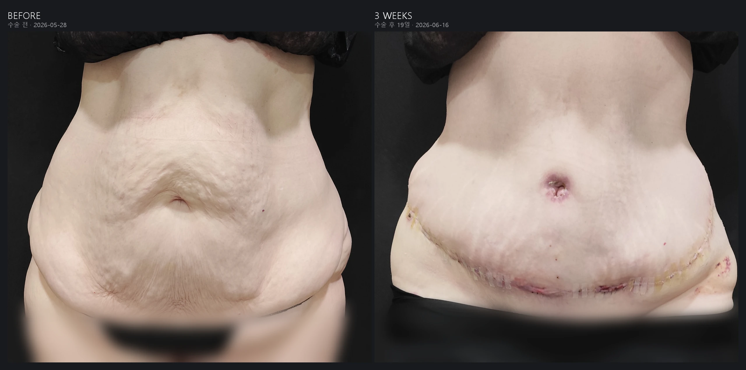 Tummy tuck before and after after major weight loss, front view, 3 weeks post-op – Evita Clinic Seoul