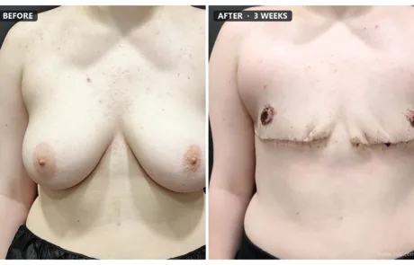 FTM top surgery before and after, front view, 3 weeks post-op – Evita Clinic Seoul