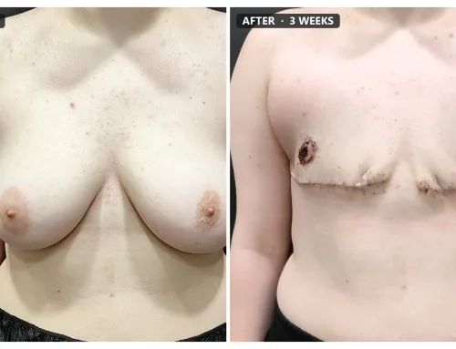 FTM Top Surgery (Double Incision with Free Nipple Graft) – 3 Weeks After Surgery