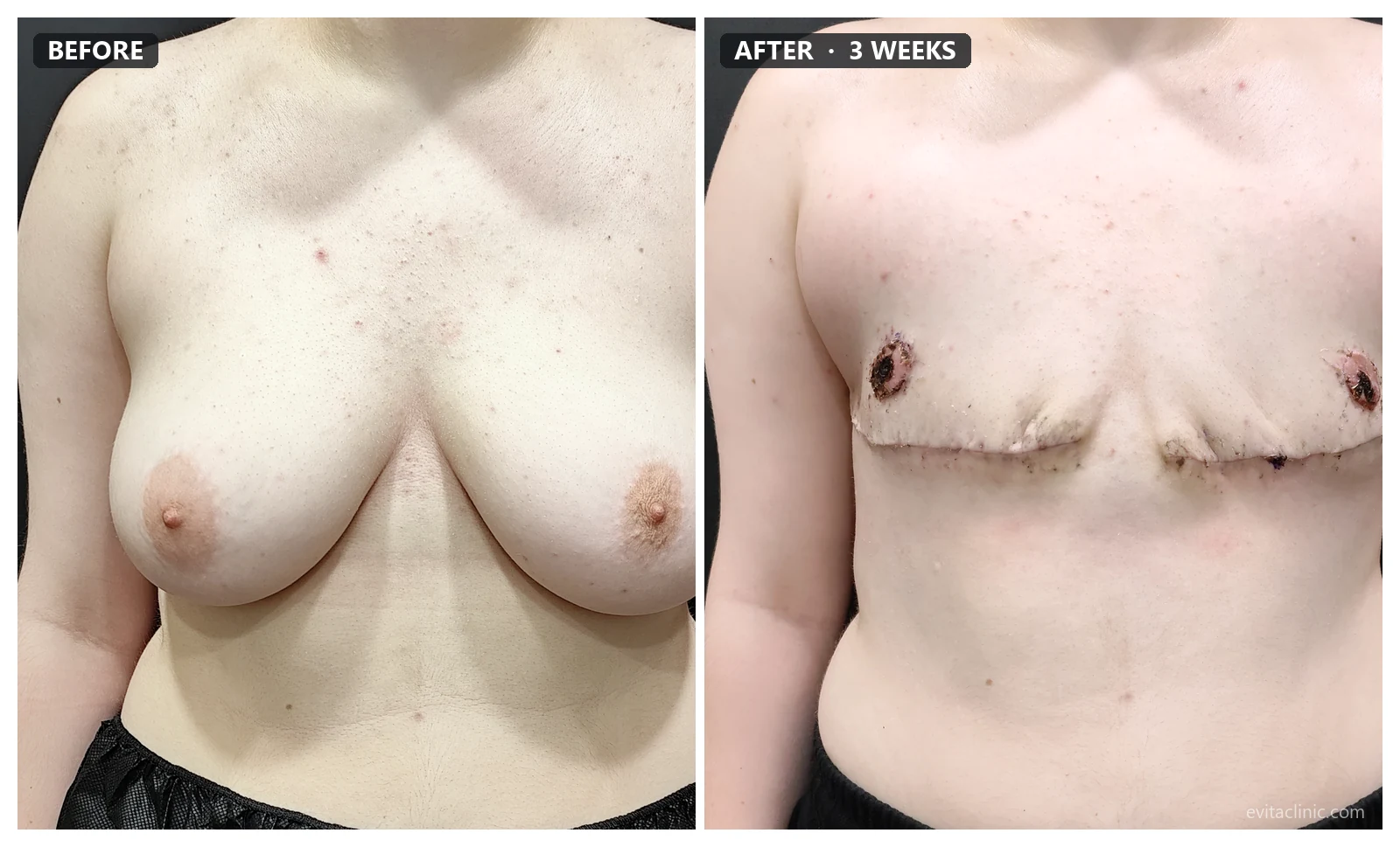 FTM top surgery before and after, front view, 3 weeks post-op – Evita Clinic Seoul