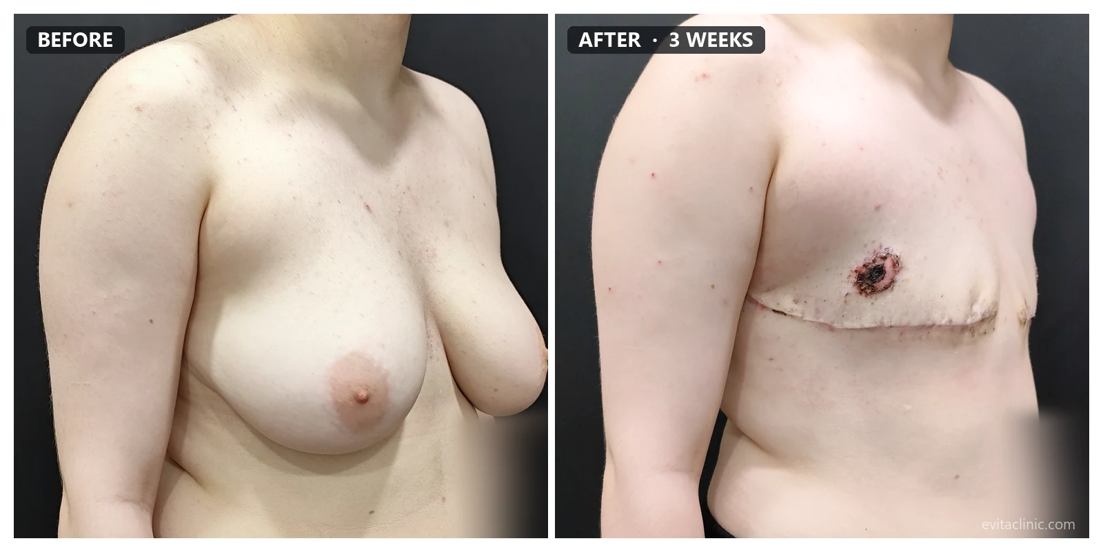 FTM top surgery before and after, oblique view, 3 weeks post-op &ndash; Evita Clinic Seoul