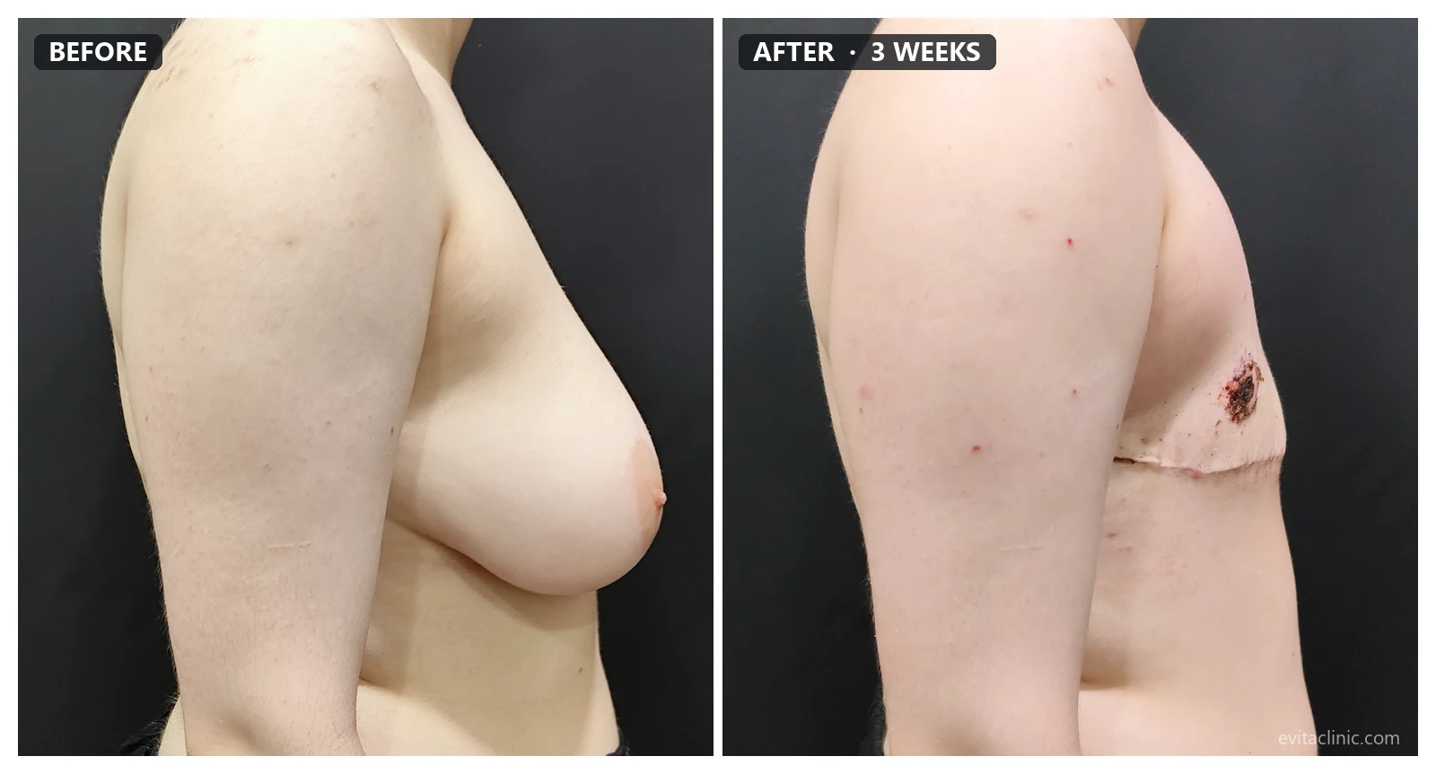 FTM top surgery before and after, side view, 3 weeks post-op &ndash; Evita Clinic Seoul