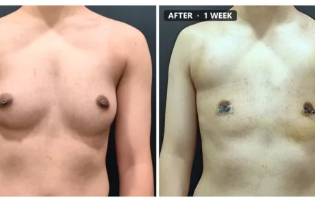 FTM top surgery before and after, front view, 1 week post-op – Evita Clinic Seoul