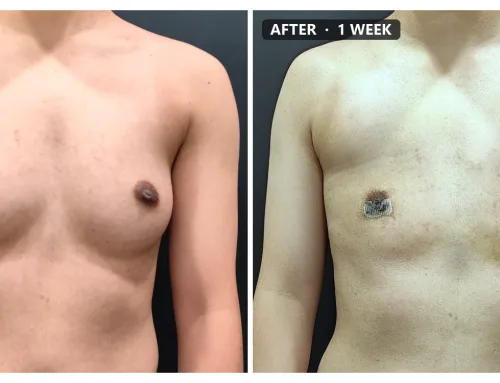FTM Top Surgery (Minimal Incision) – 1 Week After Surgery