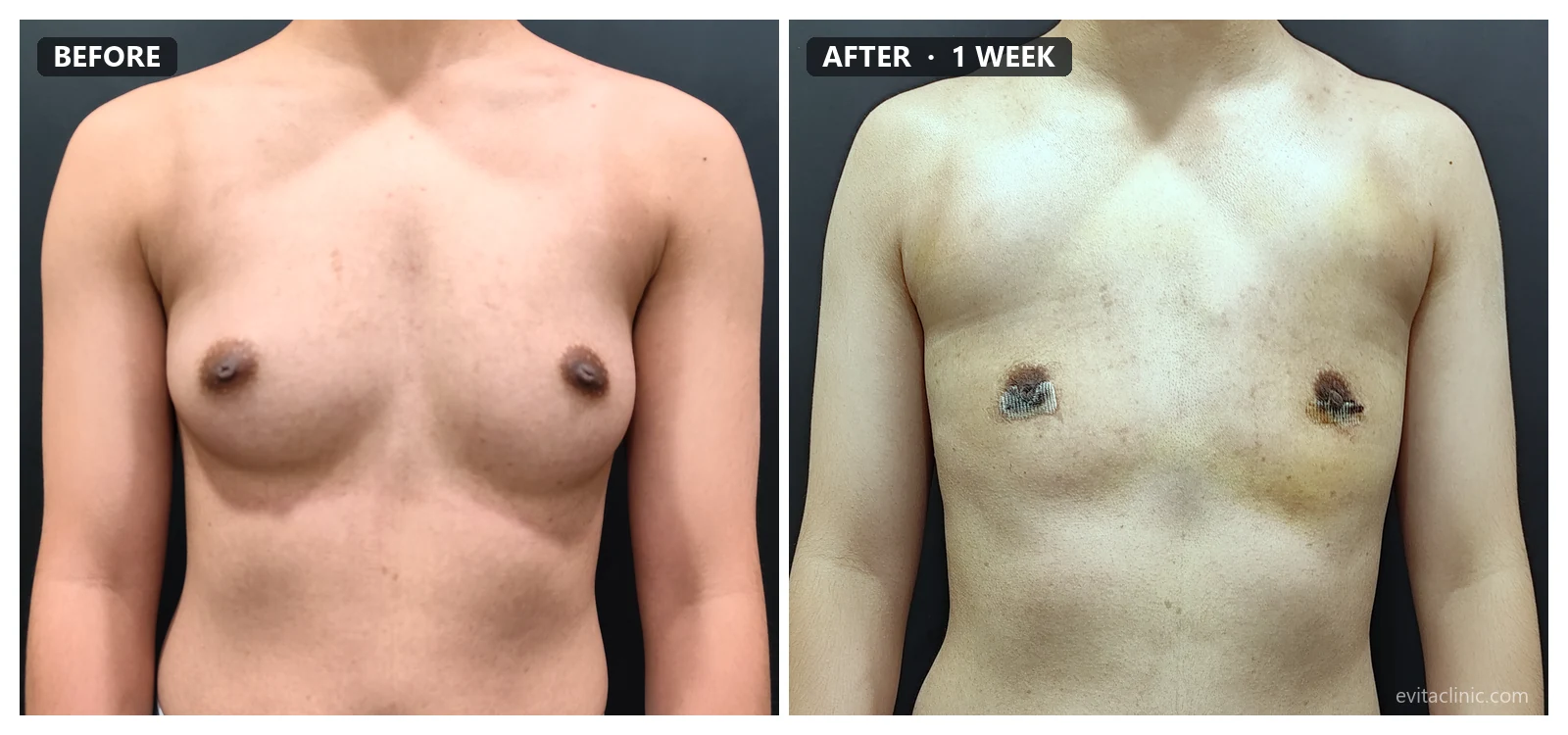 FTM top surgery before and after, front view, 1 week post-op – Evita Clinic Seoul