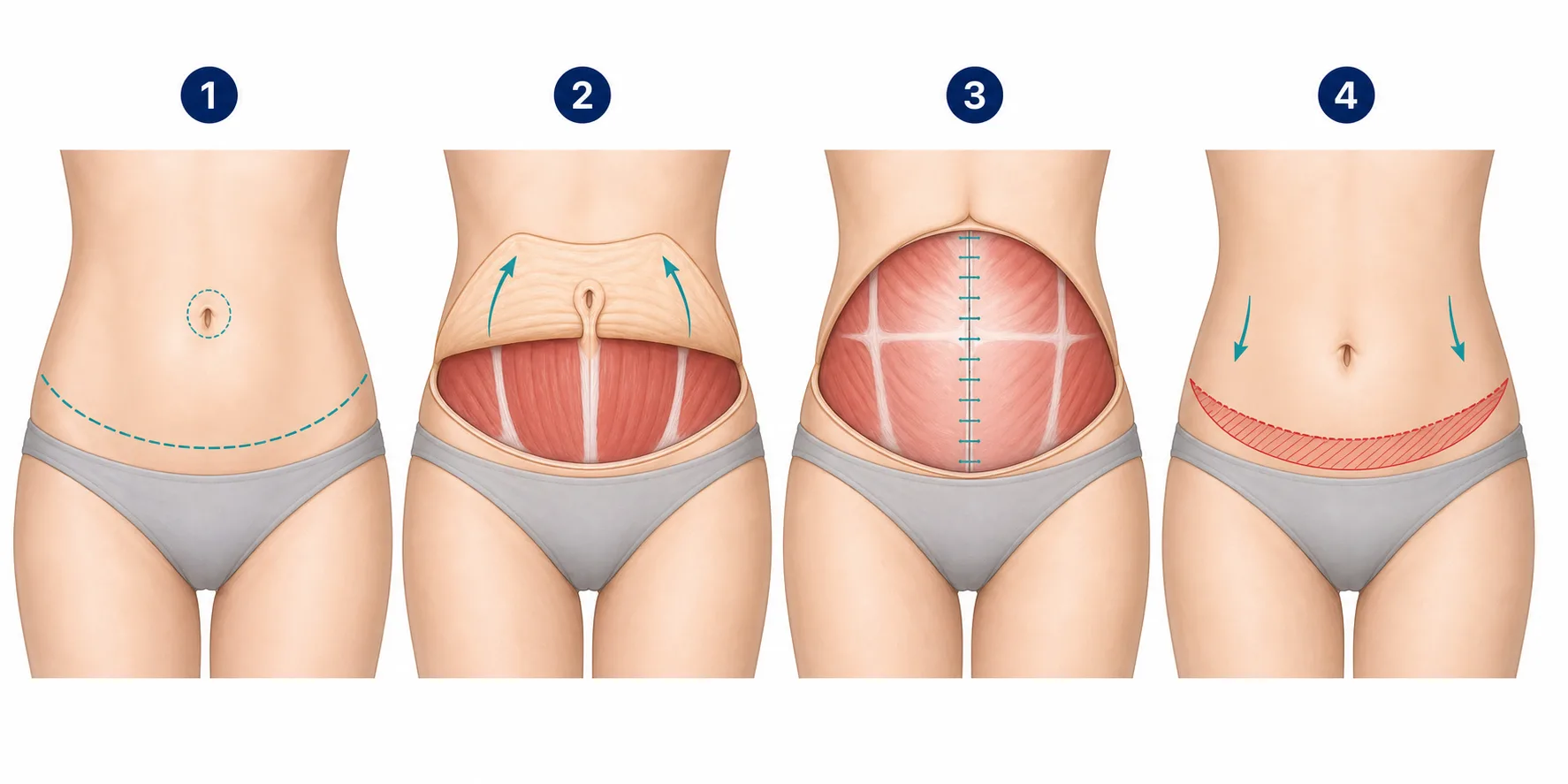 Four-step medical illustration of a full tummy tuck showing a longer low incision, wider skin elevation, broader fascia repair and larger lower-abdominal skin removal with a new belly-button opening
