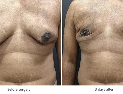 Grade 4 Gynecomastia – 3 Days After Surgery