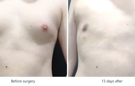 Gynecomastia with puffy nipples before and after, front view, 2 weeks post-op – Evita Clinic Seoul