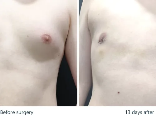 Gynecomastia with Puffy Nipples – 2 Weeks After Surgery