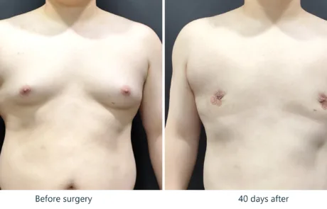Gynecomastia before and after, front view, 6 weeks post-op – Evita Clinic Seoul