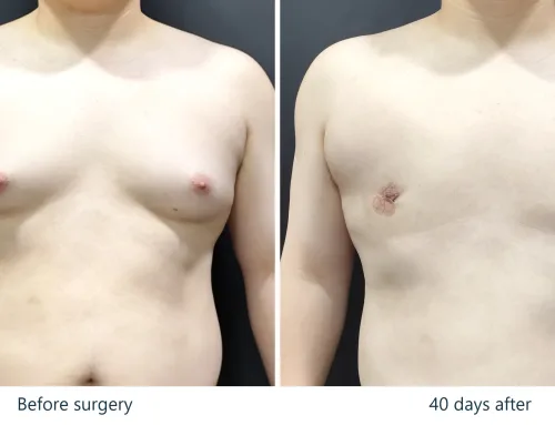 Gynecomastia Surgery (Liposuction with Glandular Excision) – 6 Weeks After Surgery