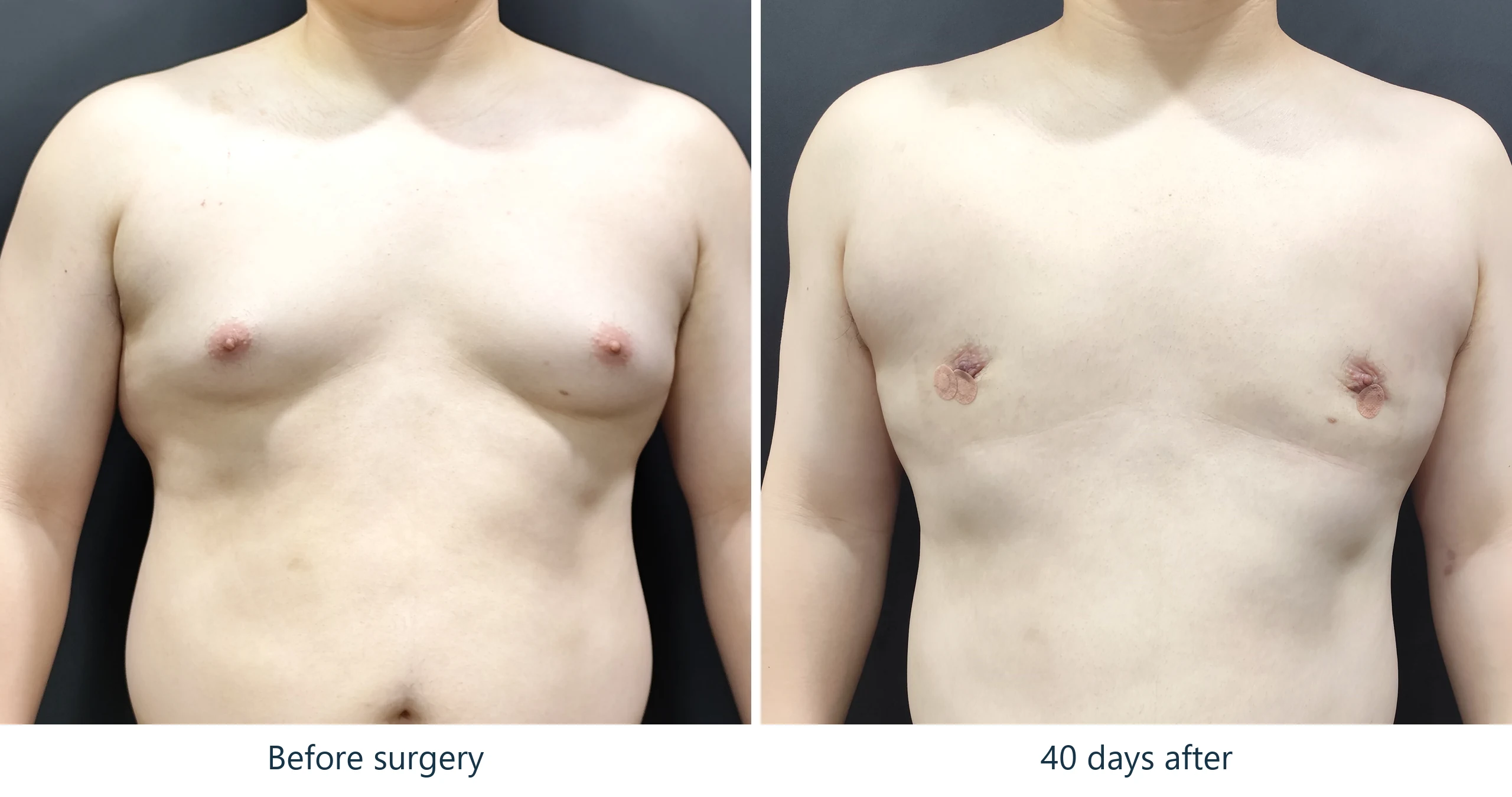Gynecomastia before and after, front view, 6 weeks post-op – Evita Clinic Seoul