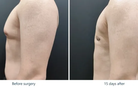 Gynecomastia before and after, side view, 2 weeks post-op showing loss of breast projection – Evita Clinic Seoul