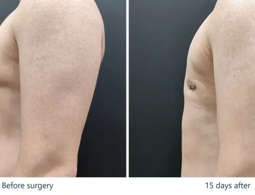 Gynecomastia Visible Only from the Side – 2 Weeks After Surgery