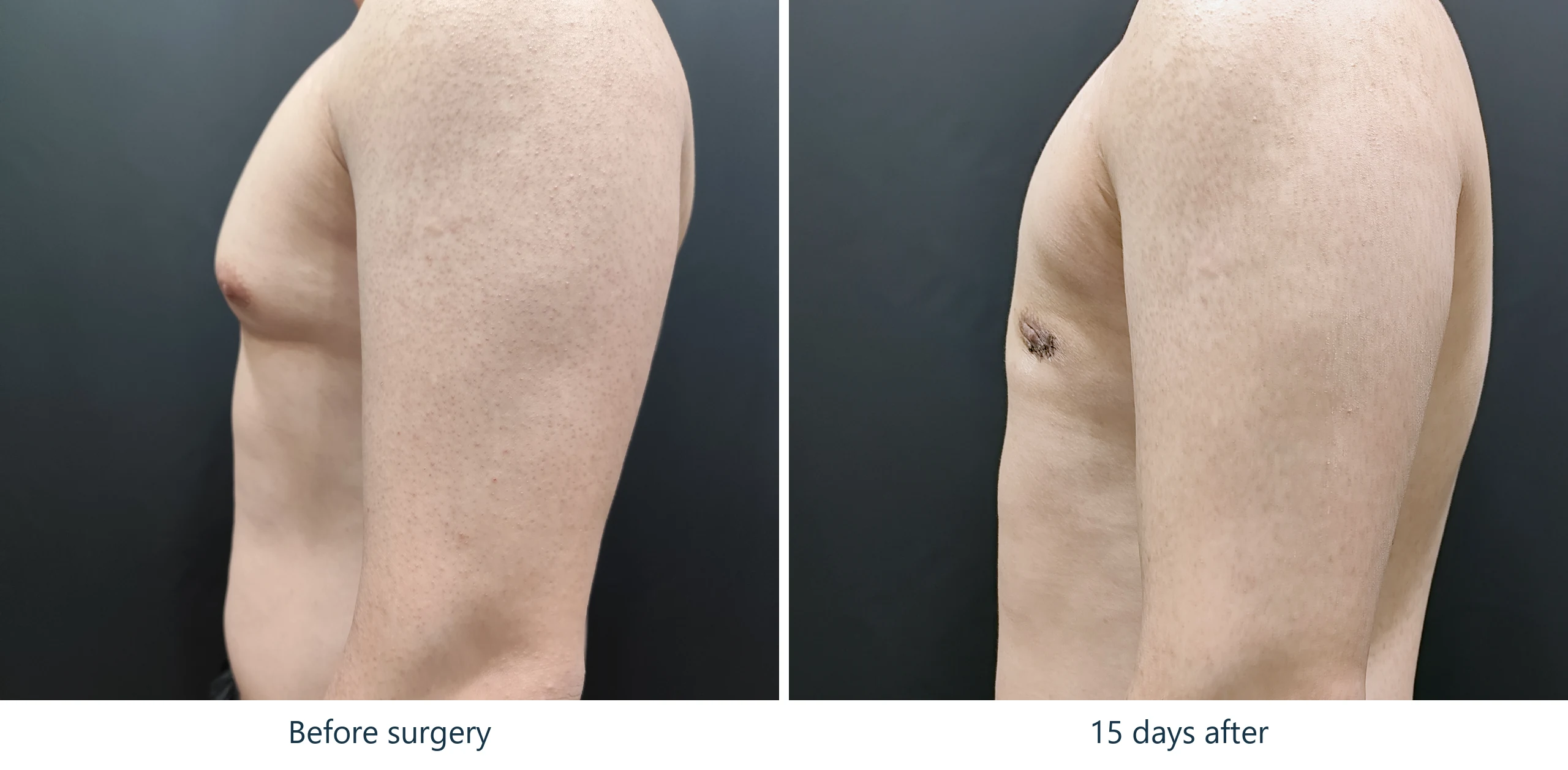 Gynecomastia before and after, side view, 2 weeks post-op showing loss of breast projection – Evita Clinic Seoul