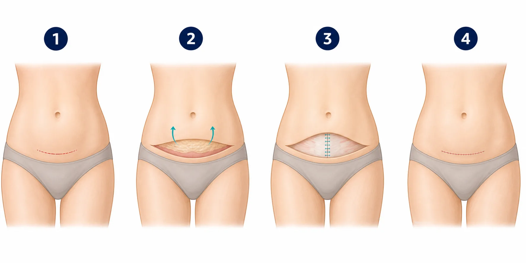 Four-step medical illustration of a mini tummy tuck showing a short low incision, limited lower-abdominal skin elevation, optional lower fascia repair and the final short scar