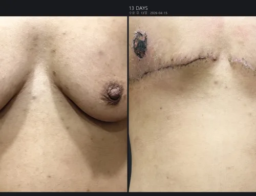 FTM Top Surgery – Free Nipple Graft Healing at 13 Days