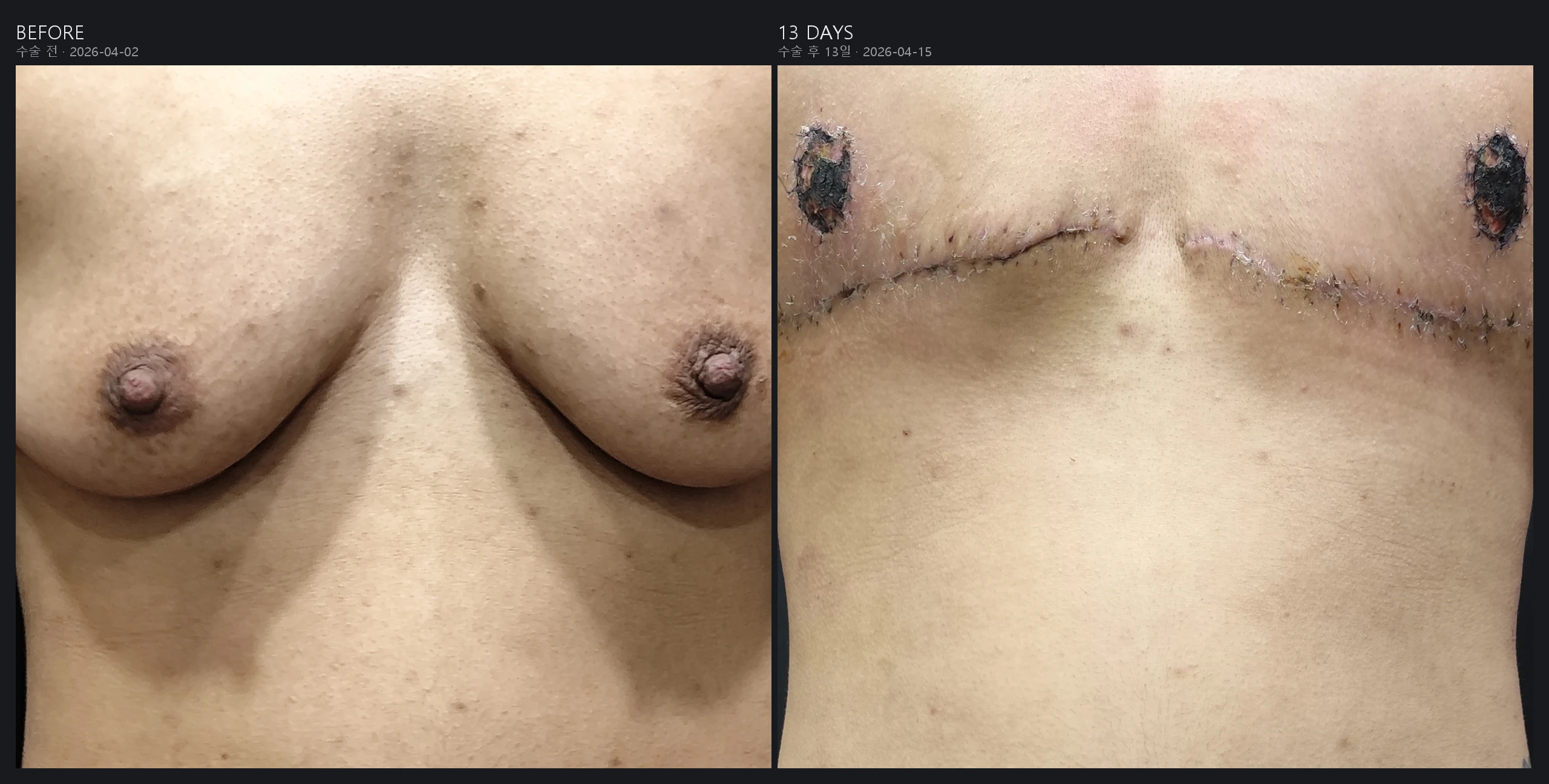 FTM top surgery double incision before and after, front view, 13 days post-op with nipple graft crusting – Evita Clinic Seoul